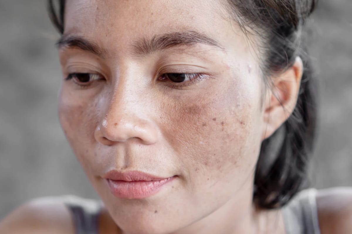 Tratamientos para manchas